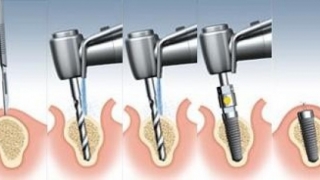 KỸ THUẬT CẤY GHÉP IMPLANT